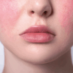 Sensitive Skin
